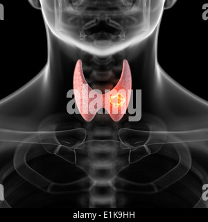 Menschliche Schilddrüse zeigt eine Tumor-Computer-Kunstwerk. Stockfoto