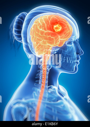 Weibliche Gehirn Tumor Computer Grafik zeigt. Stockfoto