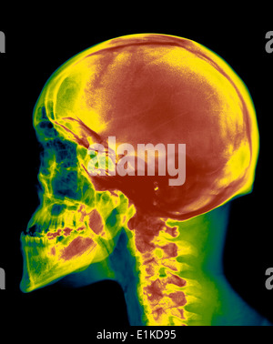 Schädel farbig x-ray des Schädels ein 30 Jahre alter Mann. Stockfoto