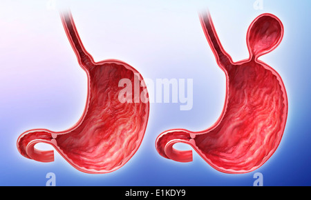 Menschlichen Magen mit Leistenbruch Cut-away Computer Artwork. Stockfoto