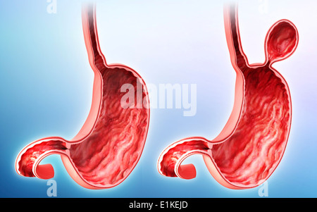 Menschlichen Magen mit Leistenbruch Cut-away Computer Artwork. Stockfoto