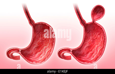 Menschlichen Magen mit Leistenbruch Cut-away Computer Artwork. Stockfoto