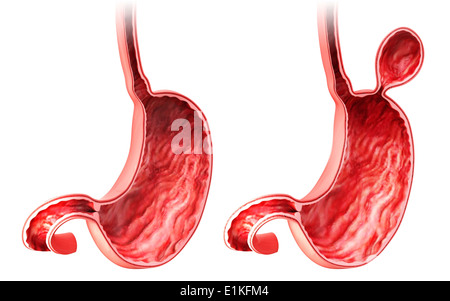 Menschlichen Magen mit Leistenbruch Cut-away Computer Artwork. Stockfoto