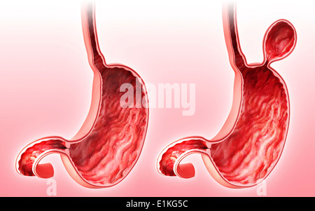 Menschlichen Magen mit Leistenbruch Cut-away Computer Artwork. Stockfoto