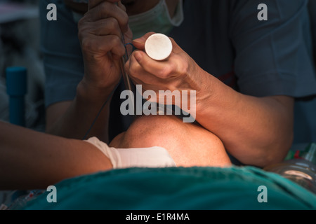 endotracheal Schlauch einlegen Stockfoto