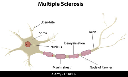 Multiple Sklerose Stockfoto