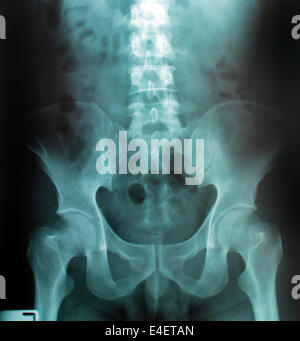 X-ray Image Of Human für eine medizinische Diagnose Stockfoto