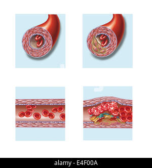 Normale Arterie im Vergleich zu Plaque und Thrombus-Bildung in Arterie. Stockfoto