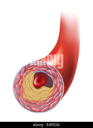 Aufbau von atherosklerotischen Plaque in einer Arterie. Stockfoto