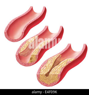 Aufbau von atherosklerotischen Plaque in einer Arterie. Stockfoto