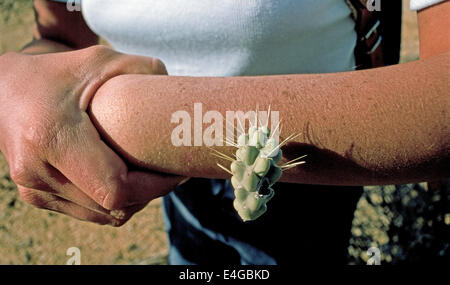 Eine Frau zeigt dem Arm wo Stacheln eines jumping Cholla Kaktus schmerzlich  ihre Haut beim Wandern in der Wste in der Nhe von Tucson, Arizona, USA  durchbohrt haben Stockfotografie - Alamy