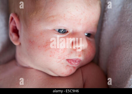 Zwei Wochen alten mit - wahrscheinlich - Neugeborenen Baby-Akne oder Erythema Toxicum Neonatorum ETN; bald nach der Geburt in vielen Fällen kommt Stockfoto