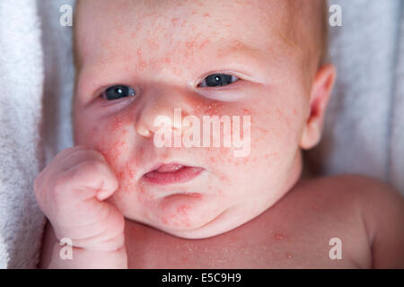 Zwei Wochen alten mit - wahrscheinlich - Neugeborenen Baby-Akne oder Erythema Toxicum Neonatorum ETN; bald nach der Geburt in vielen Fällen kommt Stockfoto