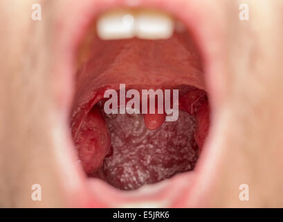 Offenem Mund Ansicht der Mandeln Stockfotografie - Alamy