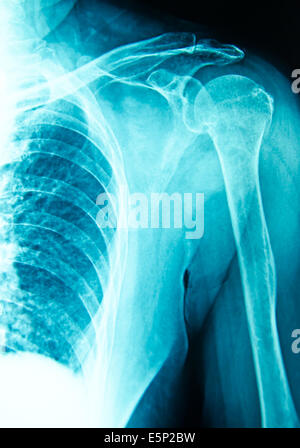 x-ray für Diagnose Verletzung der Schulter Stockfoto