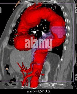 Dreidimensionale berechnete computertomographischen (CT) Scannen Rekonstruktion von mehreren Aortenaneurysmen, der Aorta ascendens (zwischen den Stockfoto