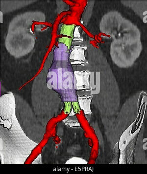 Dreidimensionale berechnete computertomographischen (CT) Scannen Wiederaufbau Ofabdominal Aortenaneurysma behandelt mit einem Stent, das Aneurysma Stockfoto