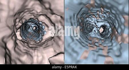 Dreidimensionale tomographische innen (CT) berechnete Scanansicht der abdominalen Aortenaneurysma (links) behandelt mit einem Stent (rechts), Stockfoto