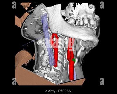 Dreidimensionale berechneten tomographische Sicht eine linke gemeinsame Halsschlagader Aneurysma auf seine Beendigung (grün) und eine ectasia Stockfoto