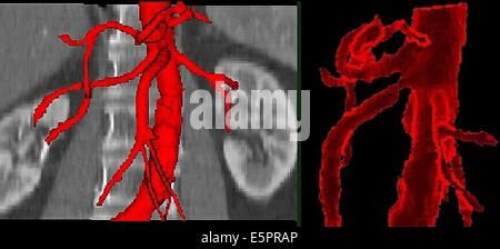 3D berechnet computertomographischen (CT) Scan Rekonstruktion einer Stenose der überlegenen mesenterialen Arterie. Stockfoto