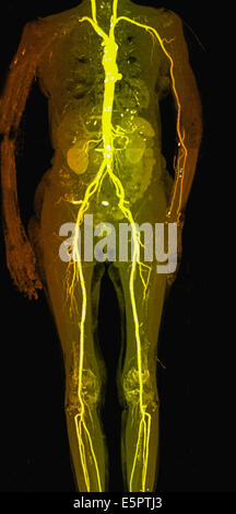 Farbige Computertomographie (CT)-Scan des gesamten arterious Systems ist im Zentrum die Aorta, die Hauptschlagader des Körpers gesehen, Stockfoto