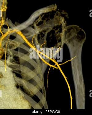 Computertomographie (CT) Wiederaufbau 3D-Scan der Schulter eine Chondrosarcoma des Schulterblattes zeigt, ist der tumor Stockfoto