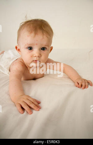 Windpocken bei einem 4 Monate alten Baby. Stockfoto