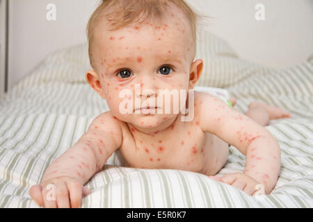 Windpocken bei einem 4 Monate alten Baby. Stockfoto