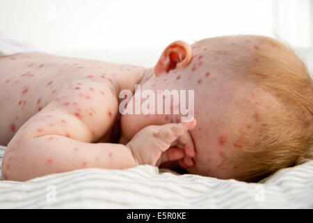 Windpocken bei einem 4 Monate alten Baby. Stockfoto