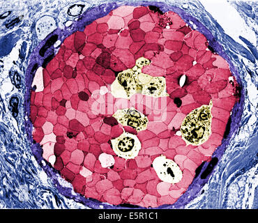 Transmission Electron Schliffbild (TEM) eines Teils der Blutgefäße voll von roten Blutkörperchen, Vergrößerung X1500. Stockfoto