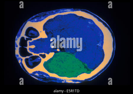 Farbige axiale berechnet Computertomographie (CT)-Scan von einem Erwachsenen Gehirn Enzephalitis in der rechten Seite zeigen zeitliche verursacht durch eine Stockfoto