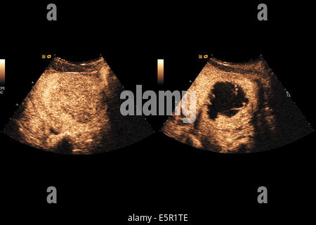 Ultraschalluntersuchung der Gebärmutter Fibrom vor der Behandlung auf der linken Seite und nach rechts. ExAblate® 2000-System mit Herrn geführte konzentriert Stockfoto