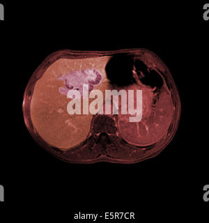 Farbige CT (Computertomographie) Scans der Leber (braun, links) von einem Patienten mit HIV mit einem Lymphom (violett, oben links). Stockfoto