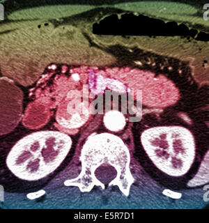 Farbige Computertomographie (CT)-Scan des Bauches zeigt einen Tumor der Bauchspeicheldrüse (Mitte). Stockfoto