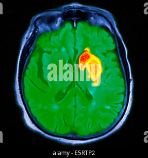 Farbige Magnetresonanz-Bildgebung (MRI)-Scan und CT eine axiale Schnitt durch das Gehirn des Patienten, zeigt den Schaden Stockfoto