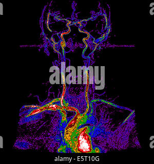 Supra Aorten Stämme (TSA) zeigt die Sicherheiten Äste der Aorta aus dem Aortenbogen: brachiocephalic arterielle Stockfoto