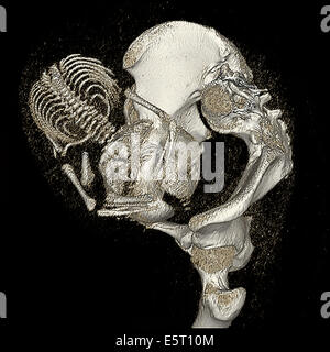 Dreidimensionale berechnete tomographische Rekonstruktion der schwangeren Frau Becken zeigt das Skelett eines 9 Monate alten Fötus, Stockfoto