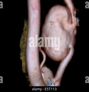 Vertebrale Arterie Aneurysm, 3D CT-Angiographie. Stockfoto