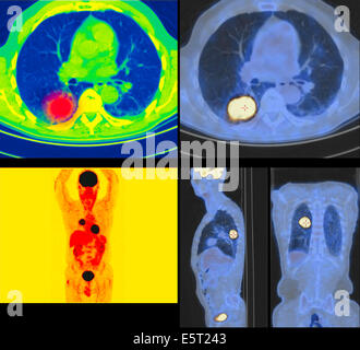 Positronen-Emissions-Tomographie (PET) Scans eines Patienten mit ...