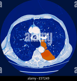 Computertomographie (CT) Scan eines Abschnitts durch die Brust eines Patienten mit einem Pneumothorax oder einer kollabierten Lunge (Orange), die Stockfoto