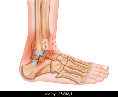 Verstauchter Knöchel, Zeichnung Stockfoto