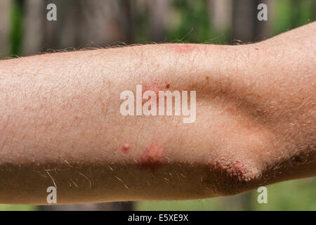 Spuren von Mückenstichen auf die menschlichen Ellbogen closeup Stockfoto