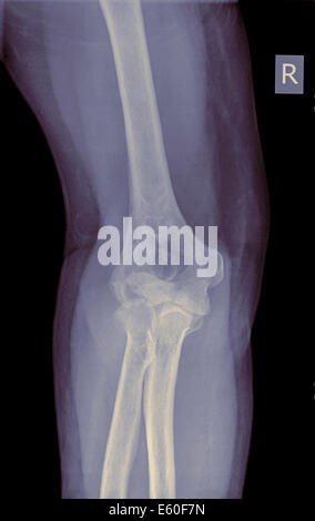 X-Ray von einem gebrochenen Ellbogen (Humerus Knochen) der eine 70 Jahre alte weibliche Patienten Vorderansicht Stockfoto