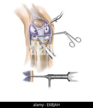 Detail der menschlichen Knie Einfügung von arthroskopischen Instrumenten zeigen. Stockfoto