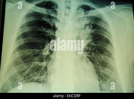 Röntgenuntersuchung der Brust für die Diagnose Stockfoto