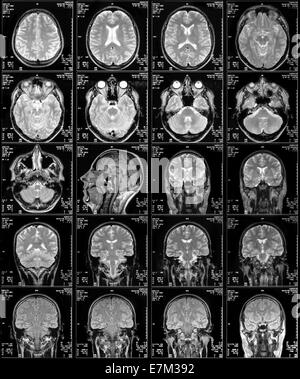 Magnetic Resonance imaging, das Bild des Kopfes in verschiedenen Ebenen Stockfoto