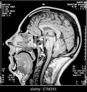 Magnetic Resonance imaging, das Bild des Kopfes in verschiedenen Ebenen Stockfoto