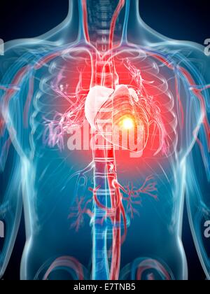 Menschlichen Herzinfarkt, Computer-Grafik. Stockfoto