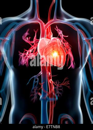 Menschlichen Herzinfarkt, Computer-Grafik. Stockfoto