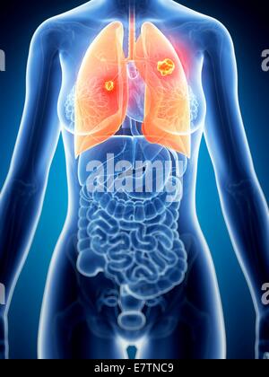 Weiblichen Lungenkrebs, Computer-Grafik. Stockfoto